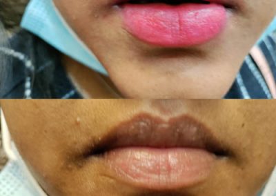 Lip pigmentation